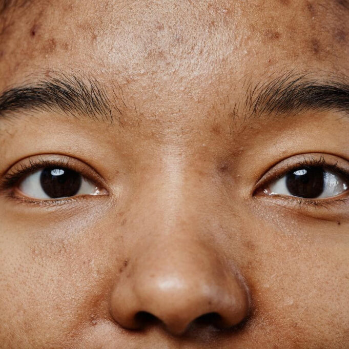 How to Get Rid of Black Spots Caused by Acne How to Get Rid of Black Spots Caused by Acne