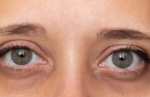 How to Remove Dark Circles Under Eyes Permanently How to Remove Dark Circles Under Eyes Permanently