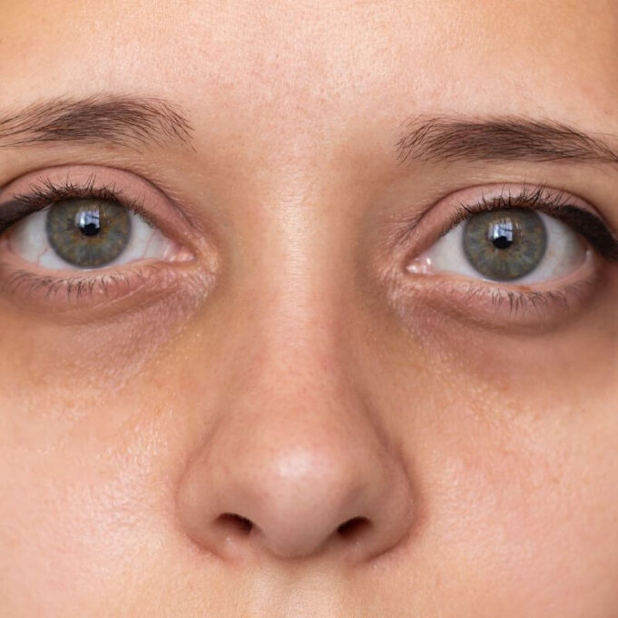 How to Remove Dark Circles Under Eyes Permanently How to Remove Dark Circles Under Eyes Permanently
