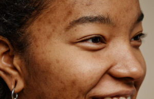 How to Treat Hormonal Acne How to Treat Hormonal Acne