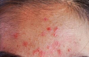 What Does Acne on Your Forehead Mean What Does Acne on Your Forehead Mean