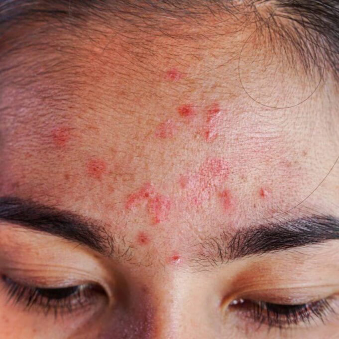 What Does Acne on Your Forehead Mean What Does Acne on Your Forehead Mean