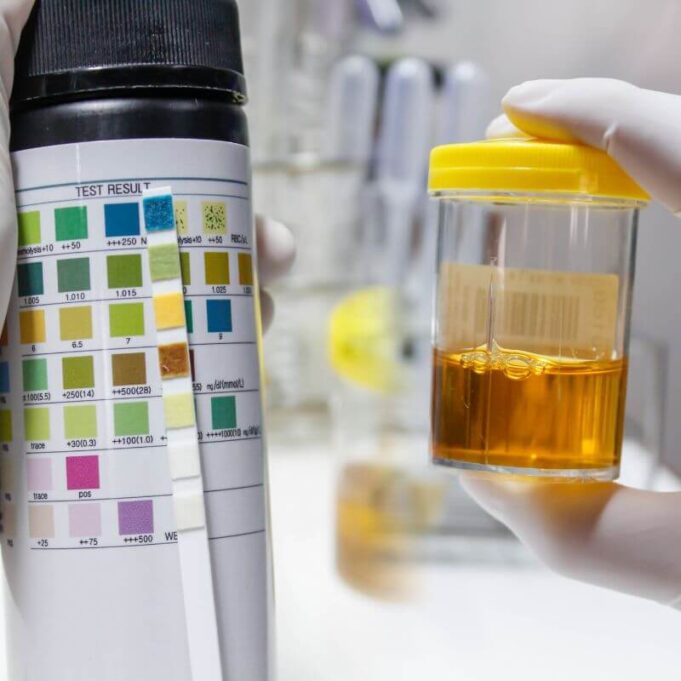Why Is My Urine Dark Yellow Why Is My Urine Dark Yellow