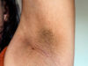 Fast Home Remedies for Underarm Whitening Fast Home Remedies for Underarm Whitening