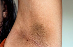 Fast Home Remedies for Underarm Whitening Fast Home Remedies for Underarm Whitening