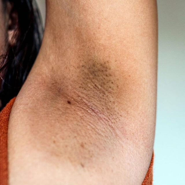 Fast Home Remedies for Underarm Whitening