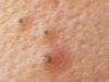 Home Remedies for Pimple and Dark Spots Home Remedies for Pimple and Dark Spots