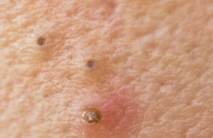 Home Remedies for Pimple and Dark Spots Home Remedies for Pimple and Dark Spots