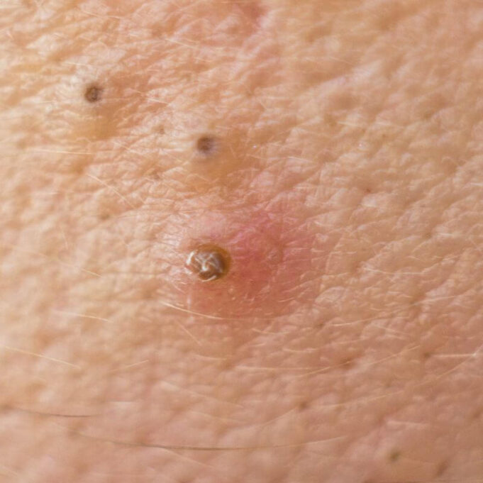 Home Remedies for Pimple and Dark Spots Home Remedies for Pimple and Dark Spots