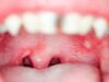 How to Cure Mouth Ulcers Fast Naturally How to Cure Mouth Ulcers Fast Naturally