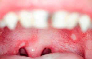 How to Cure Mouth Ulcers Fast Naturally How to Cure Mouth Ulcers Fast Naturally
