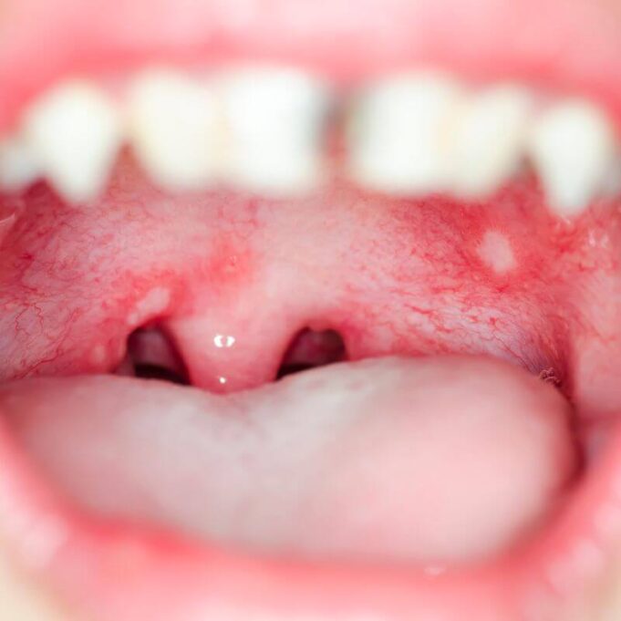 How to Cure Mouth Ulcers Fast Naturally How to Cure Mouth Ulcers Fast Naturally