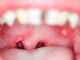 How to Cure Mouth Ulcers Fast Naturally How to Cure Mouth Ulcers Fast Naturally