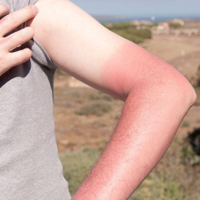 How to Restore Your Skin Colour After Sunburn How to Restore Your Skin Colour After Sunburn