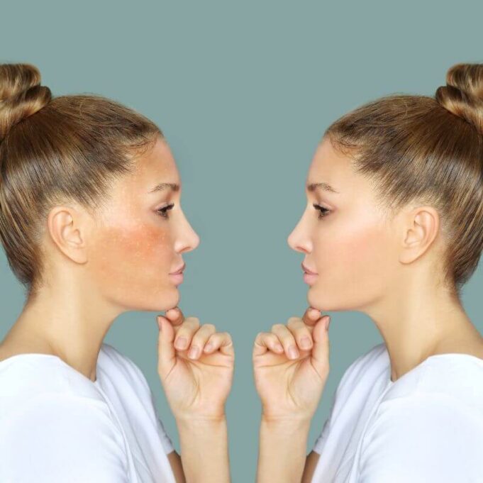 Skin Lightening Treatment Cost Skin Lightening Treatment Cost