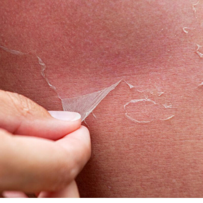 Skin Peeling on Hands Treatment Skin Peeling on Hands Treatment