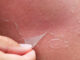 Skin Peeling on Hands Treatment Skin Peeling on Hands Treatment