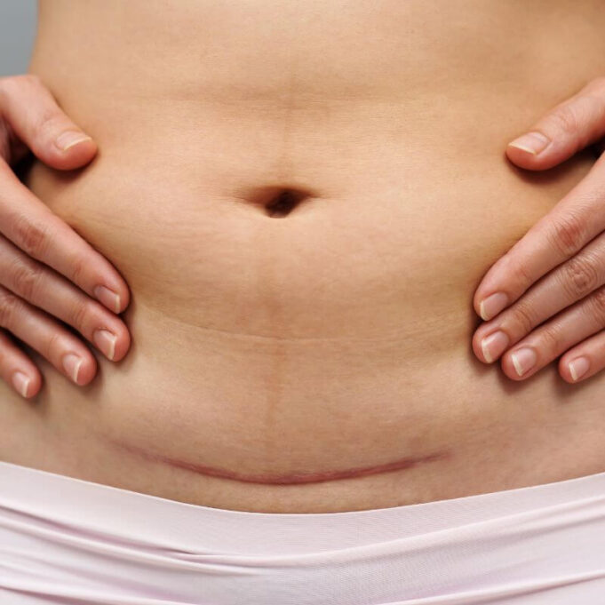 Ways to Tighten Loose Skin on Stomach After C Section Ways to Tighten Loose Skin on Stomach After C Section